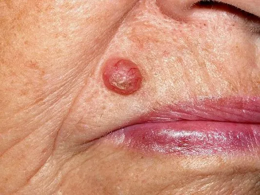 Carcinoma Doutor Dermato